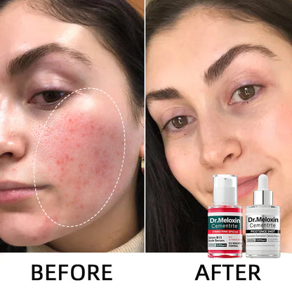 ✨Final 3 Hours: 50% OFF 💥Spot Care Duo | Shrinks Pores & Fades Blemish Marks in 2 Weeks | Cyano Pink Spicule Serum+ Picotonic Shot Ampoule(Two bottles form a set)