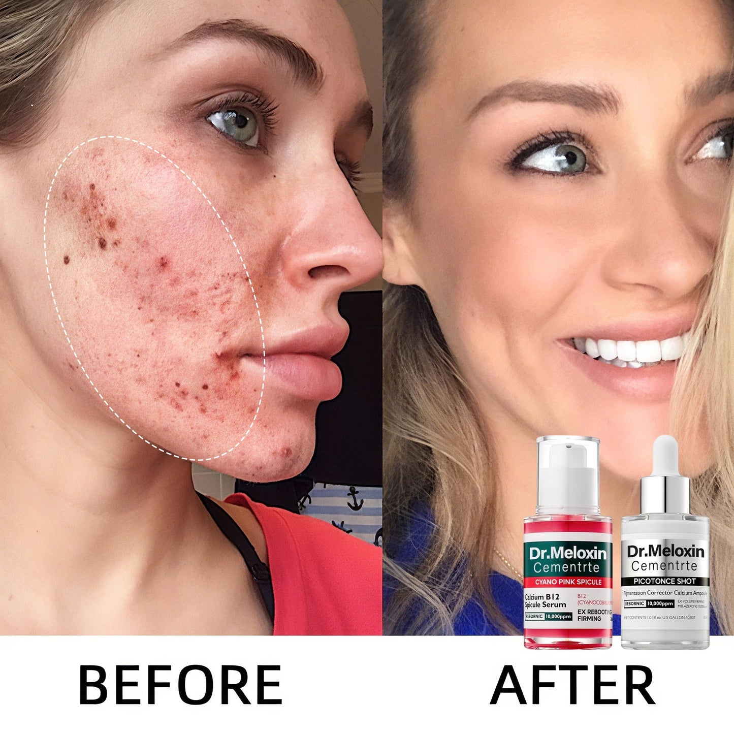 ✨Final 3 Hours: 50% OFF 💥Spot Care Duo | Shrinks Pores & Fades Blemish Marks in 2 Weeks | Cyano Pink Spicule Serum+ Picotonic Shot Ampoule(Two bottles form a set)