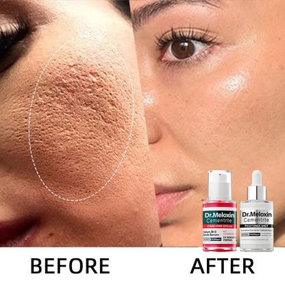 ✨Final 3 Hours: 50% OFF 💥Spot Care Duo | Shrinks Pores & Fades Blemish Marks in 2 Weeks | Cyano Pink Spicule Serum+ Picotonic Shot Ampoule(Two bottles form a set)
